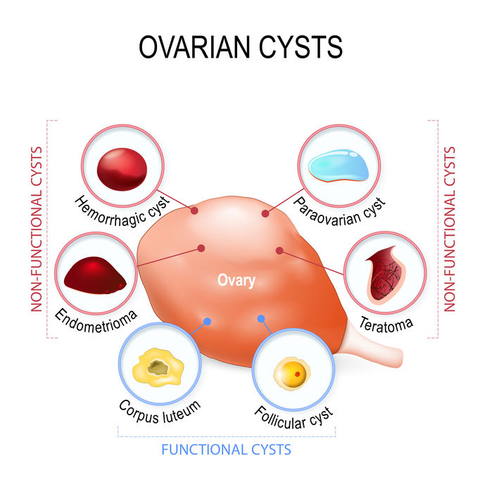 An ovarian cyst is a fluid-filled sac that forms on or within an ovary.  Ovarian cysts are quite common and often form during the menstrua